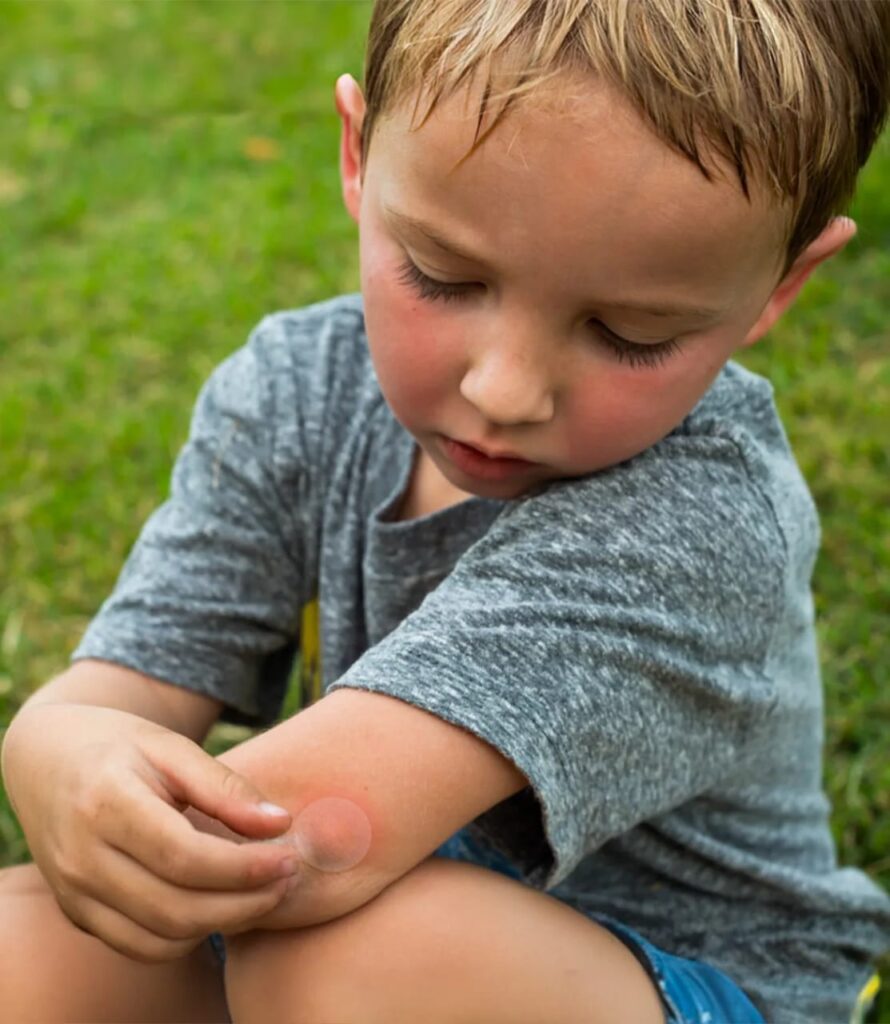 How to Make Mosquito Bites Stop Itching in Mere Seconds